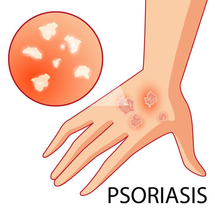 Psoriasis, De EetLijn