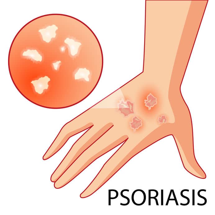 Psoriasis, De EetLijn