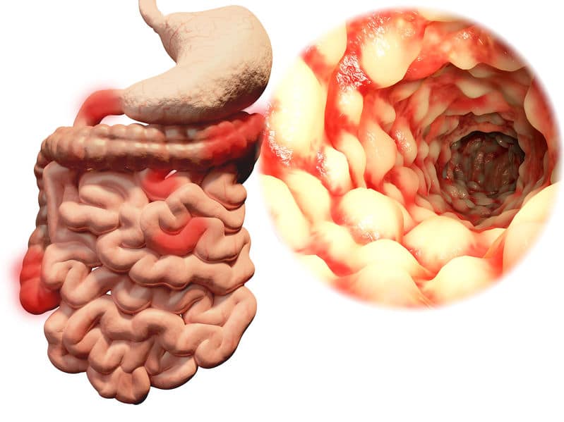 Crohn, De EetLijn