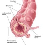 Diverticulose, De EetLijn