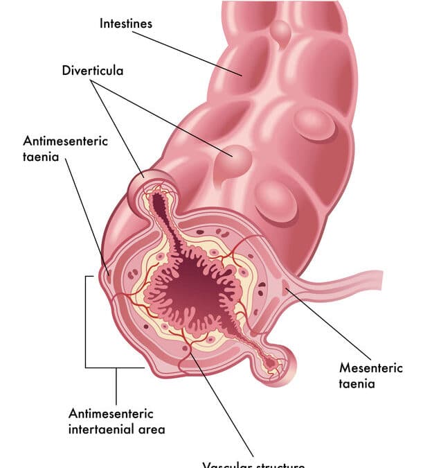 Diverticulose, De EetLijn