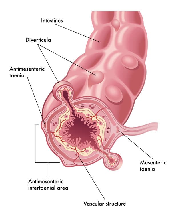 Diverticulose, De EetLijn