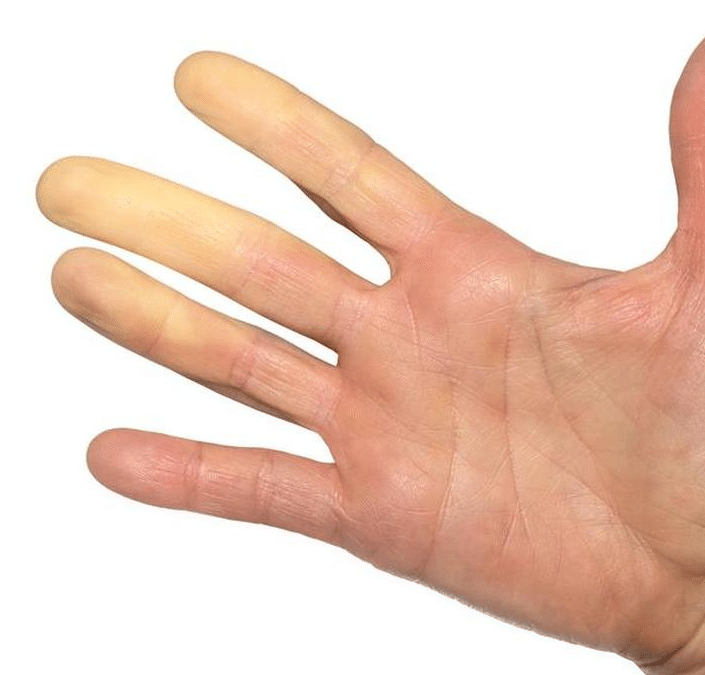 Raynaud, De EetLijn
