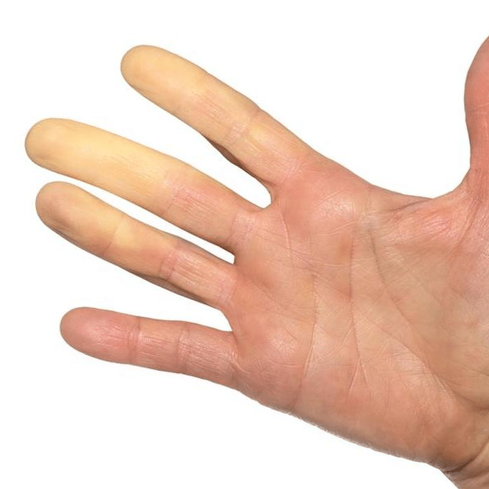 Raynaud, De EetLijn