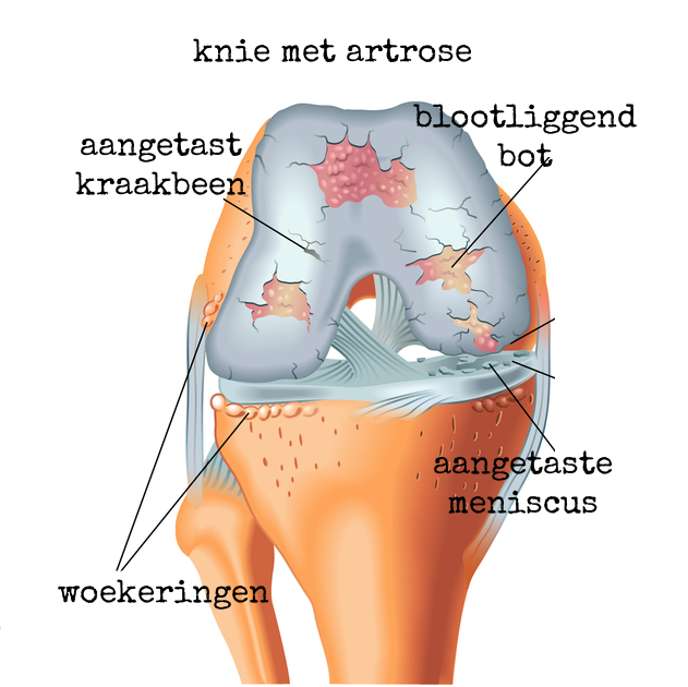 Artrose, De EetLijn