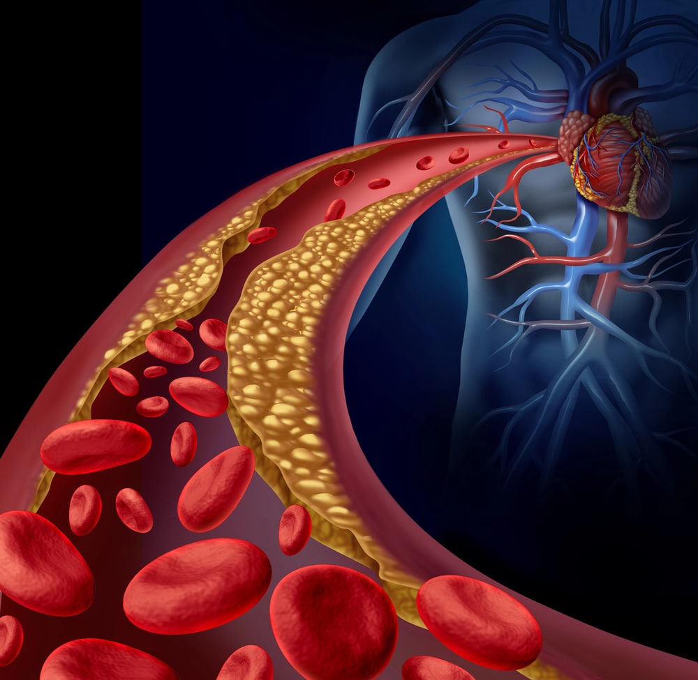 Atherosclerose, De EetLijn